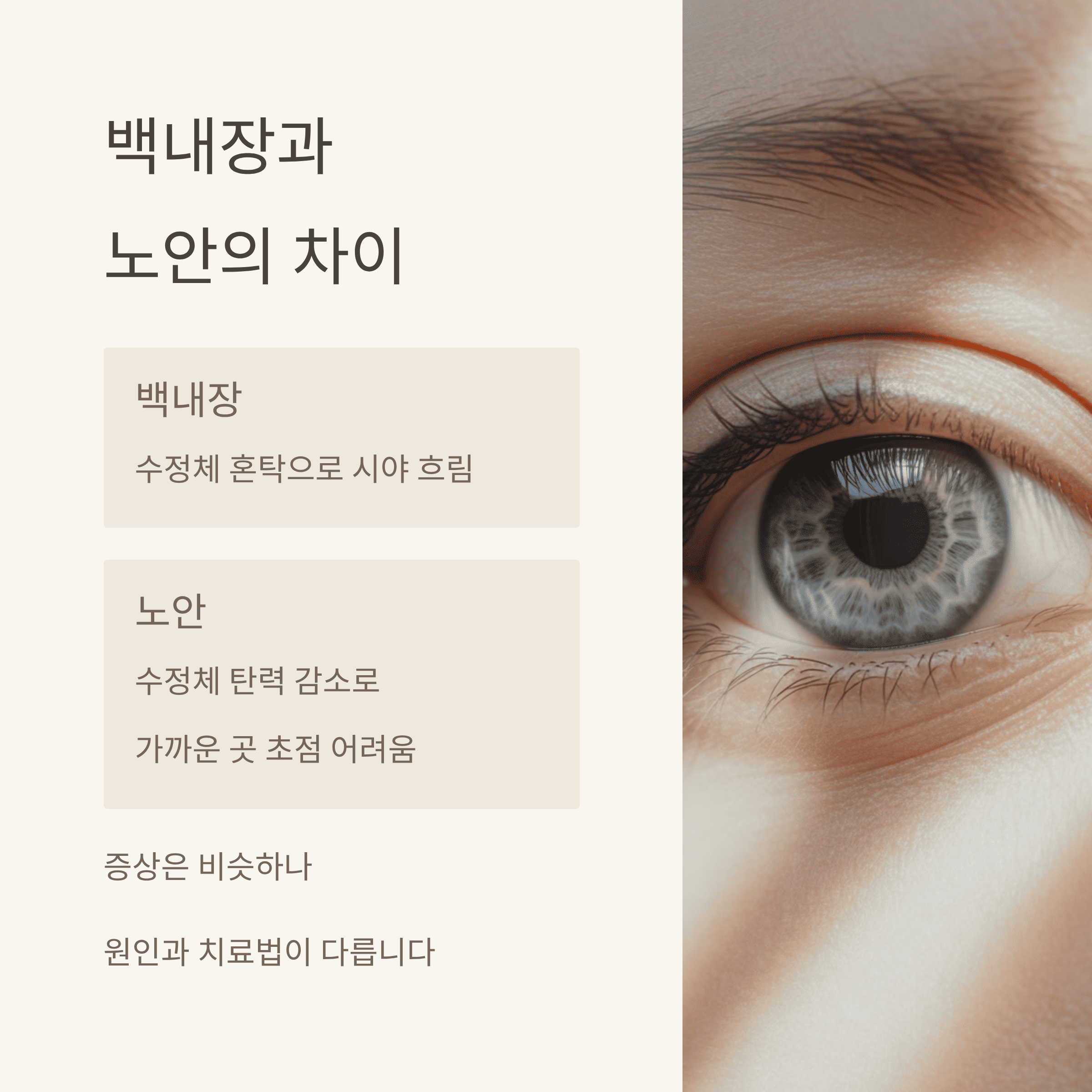 백내장(Cataracts) 증상과 치료 방법