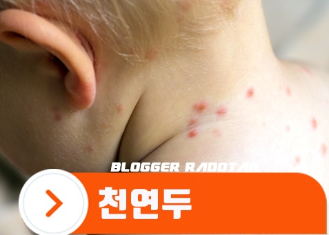 천연두가 나타난 피부사진