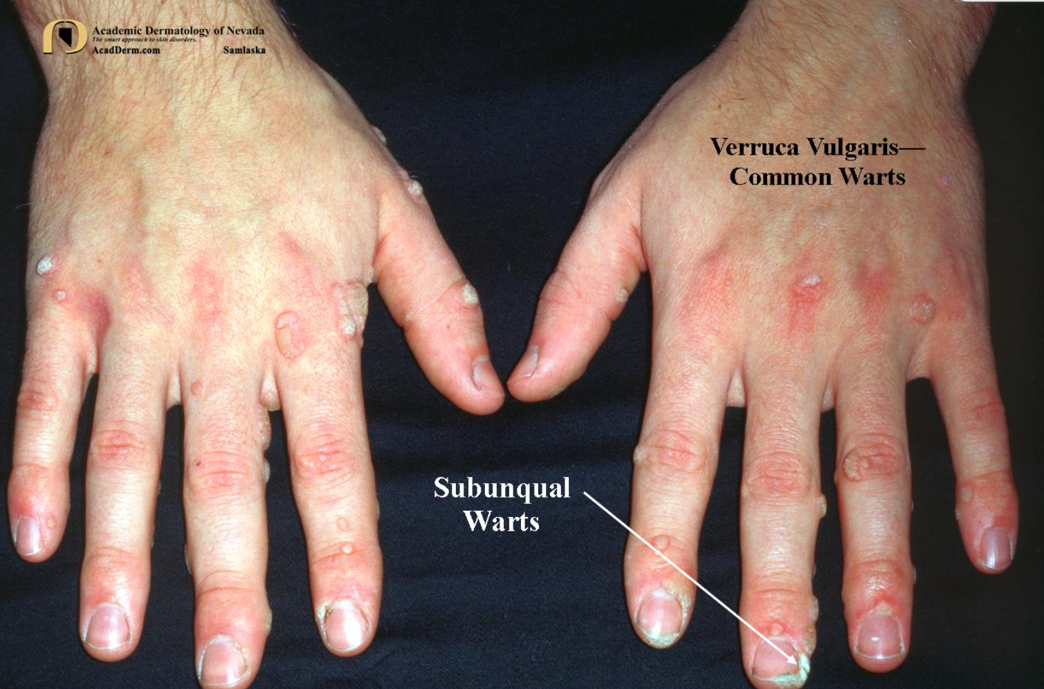 편평사마귀 원인&amp;#44; 증상&amp;#44; 치료 및 주의사항