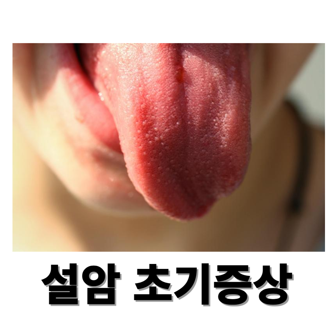 설암과 관련된 사진입니다.