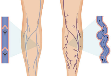 하지정맥류 증상 수술비용 좋은운동 등 총정리(2024 최신)
