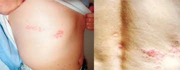 대상포진 초기증상 10가지