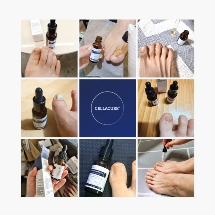 셀라큐어 문제성 발톱 솔루션 내돈내산 후기 부작용 성분 효능 사용법 가격
