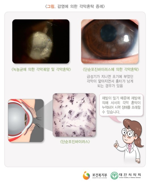 각막혼탁