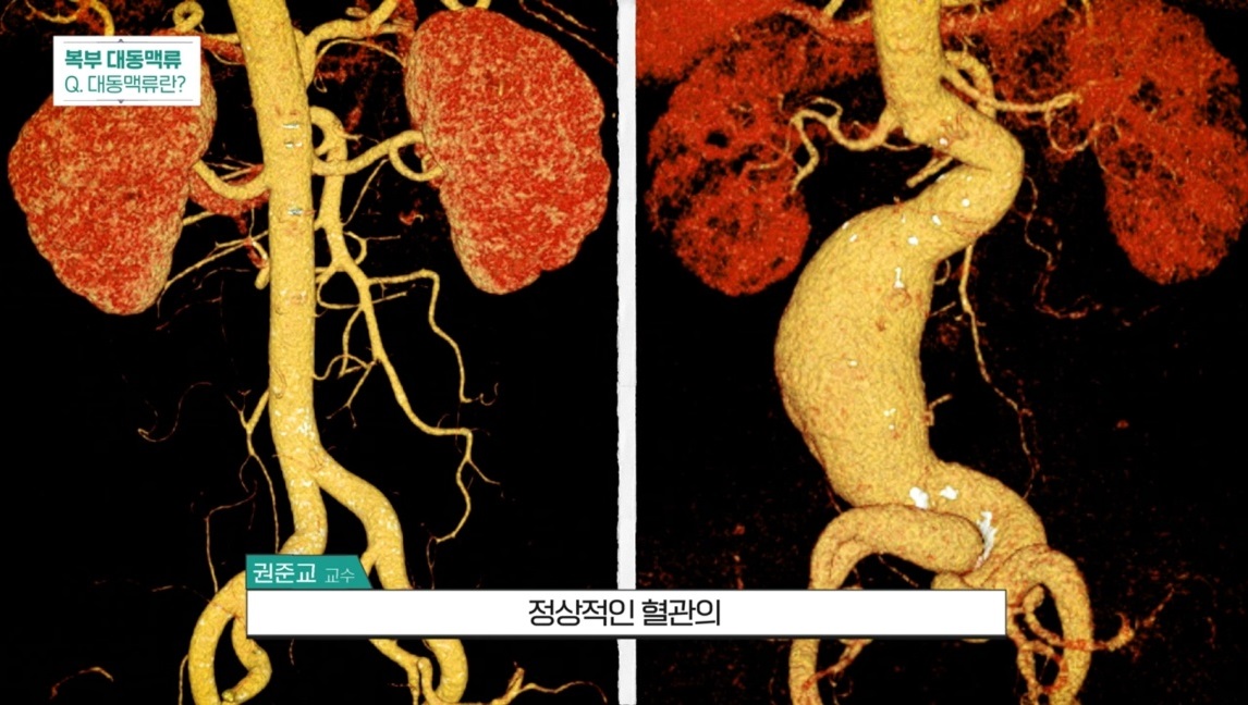 명의-복부-대동맥-강진모-교수