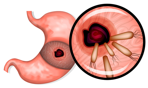헬리코박터 제균 치료로 고령층 위암 예방 효과 관련 이미지