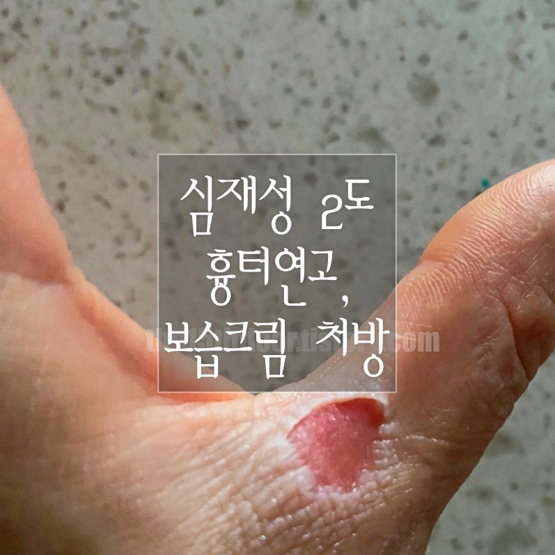 심재성 2도 화상