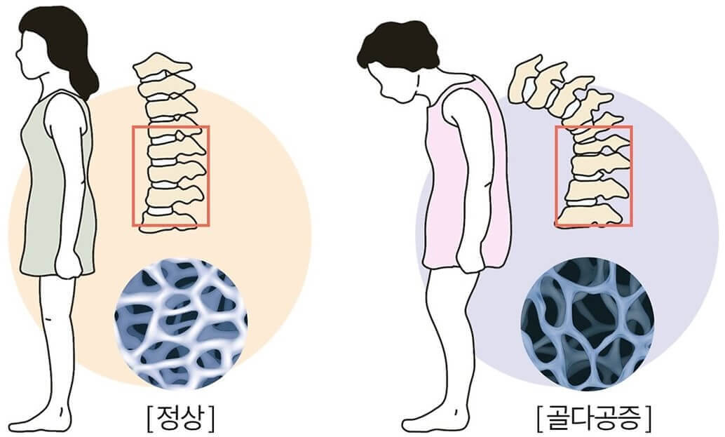 정상과 골다공증 뼈구조