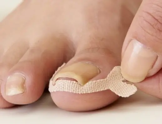 내성발톱 테이프