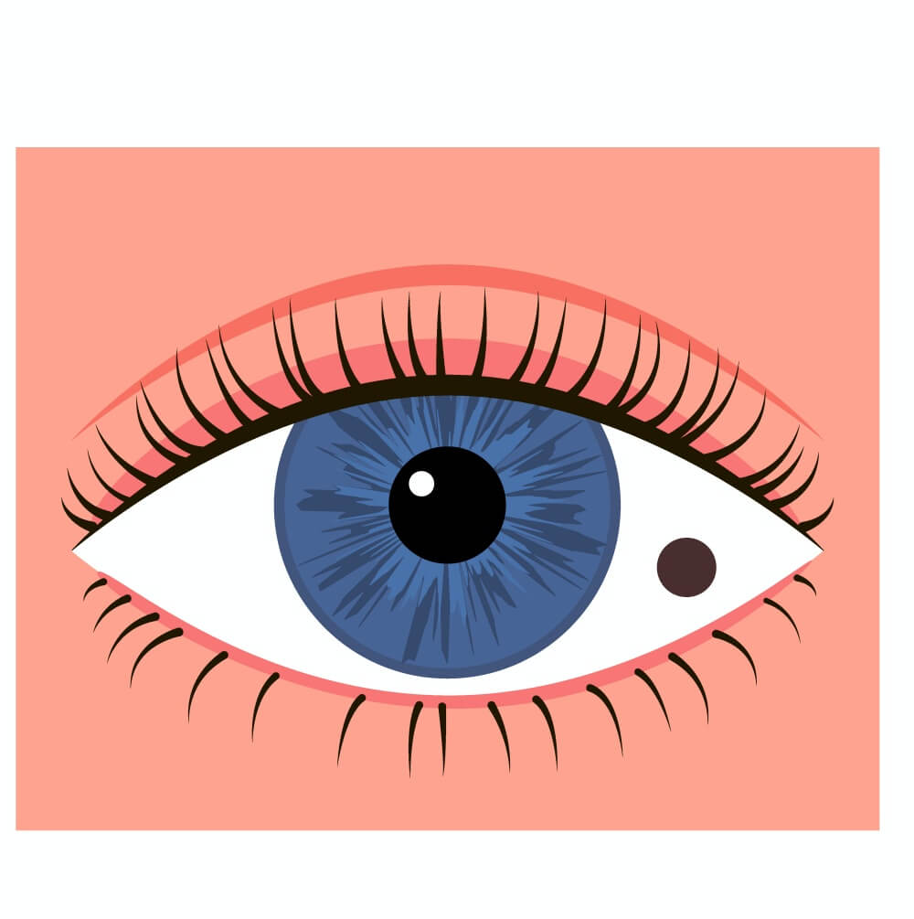 눈에-점이-생긴-결막모반