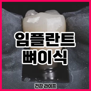 임플란트 뼈이식