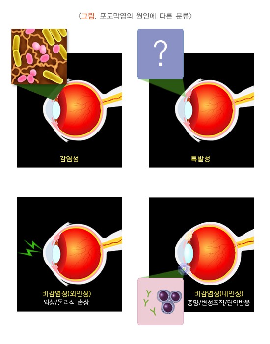 포도막염