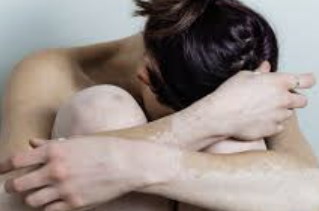 백반증 초기증상 27