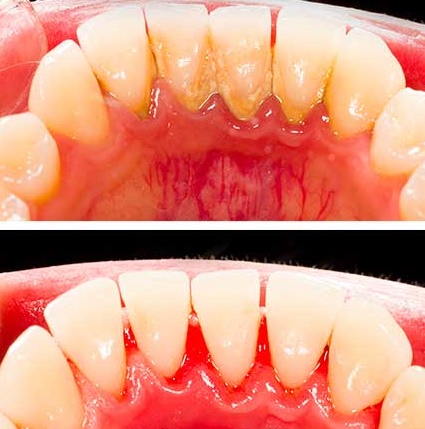 스케일링 비포 앤 에프터