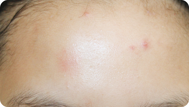 밀크시슬-효과-여드름개선