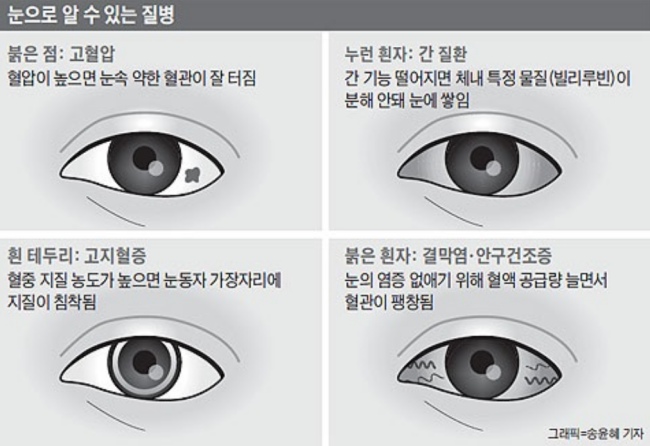눈이 노래지는 이유와 간 건강의 연관성