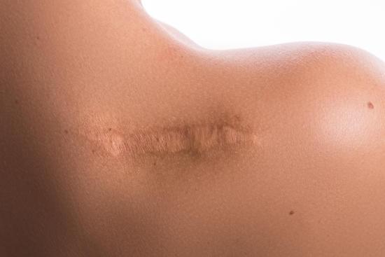 서브시전(Subcision) – 흉터 치료를 위한 효과적인 시술법