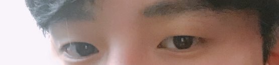 안검하수 후기