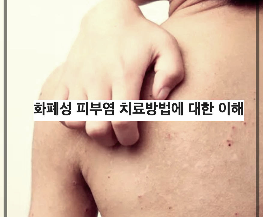 화폐성 피부염 치료방법에 대한 이해