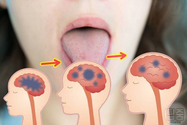 치매 안걸리는 방법 뇌위축 치매예방 혀운동 효과
