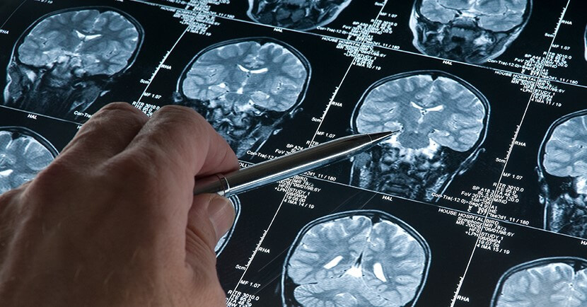 뇌종양 진단