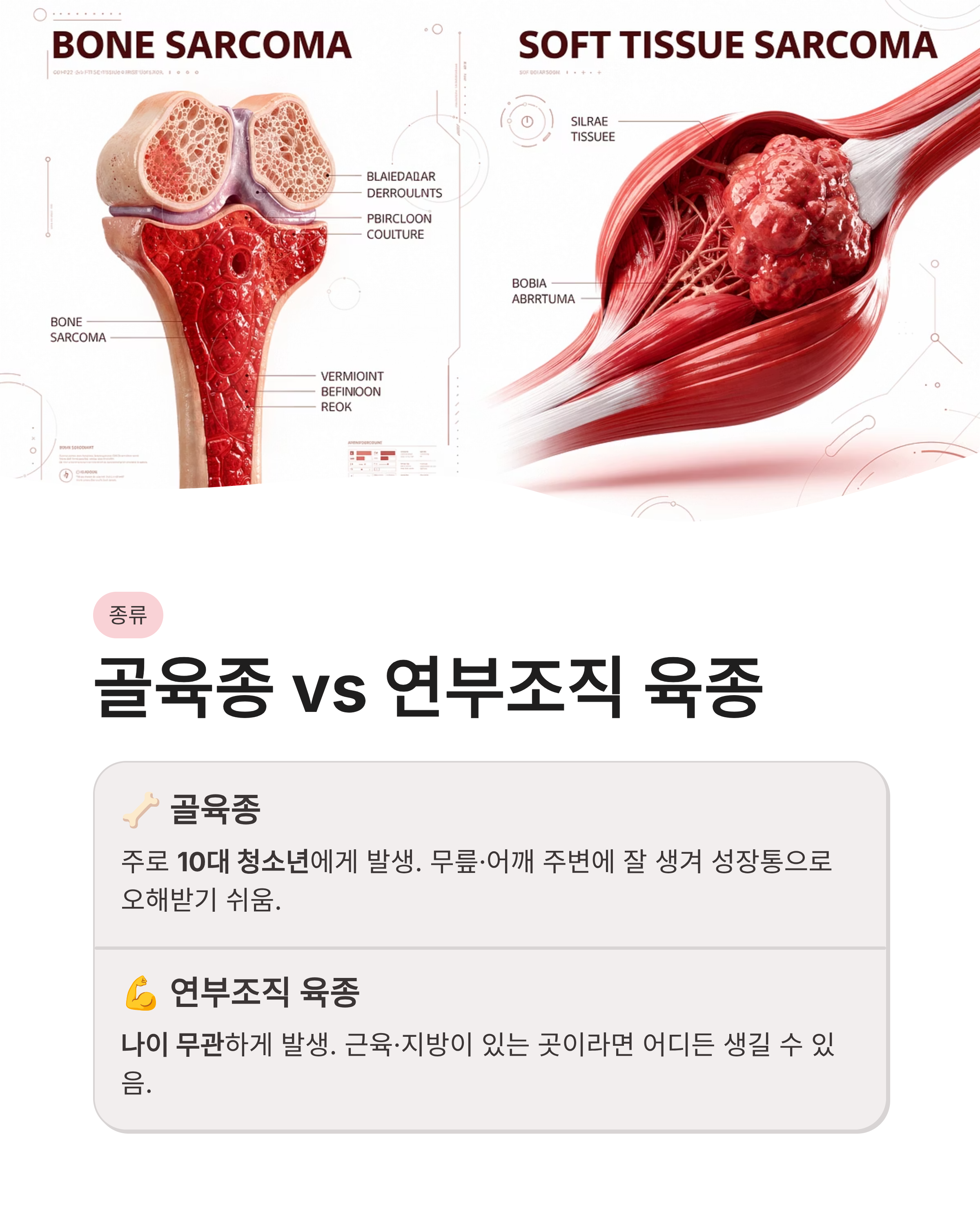 육종암 증상과 초기증상 및 생존율 총정리, 놓치면 안 되는 몸의 신호는?