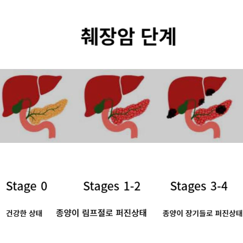 췌장암 단계