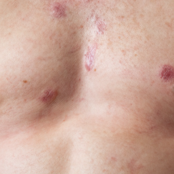 2. 콜린성 두드러기의 원인