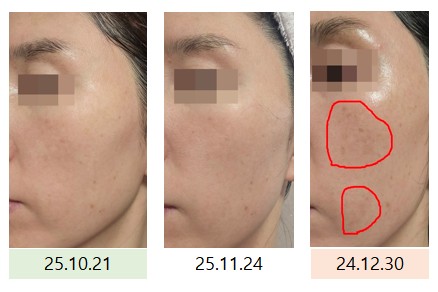 2025년 11월 과채 주스 먹은 후 오른쪽 얼굴 피부 변화 사진