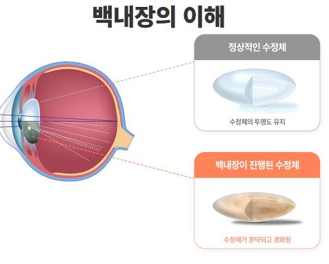 백내장이란