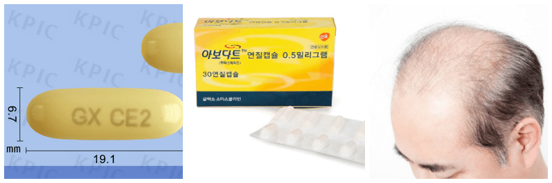 아보다트 연질캡슐, 탈모 사진