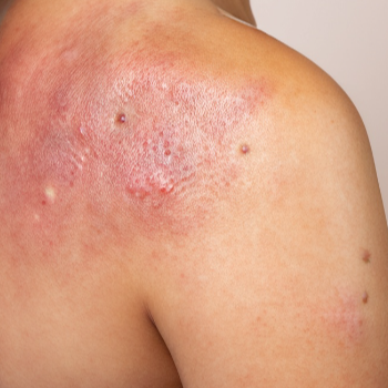 3. 콜린성 두드러기의 대처법