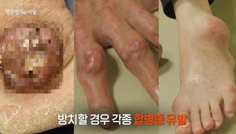통풍합병증