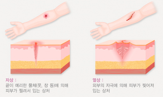 열상-자상-차이
