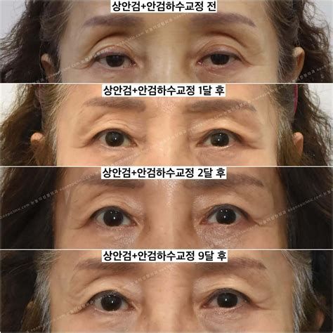 안검하수 비용