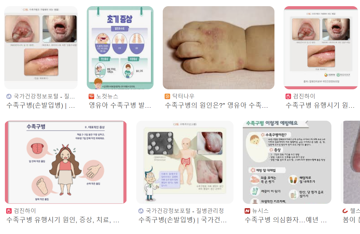 수족구 증상 2