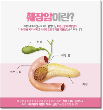 췌장암 초기증상과 진단 지연의 원인 &ndash; 왜 침묵의 암인가