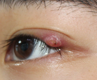 약국에서 눈 다래끼 빨리 낫는 법 : 형개연교탕 + 항생제 안약