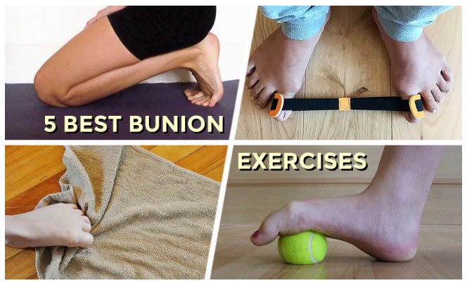 무지외반증 운동