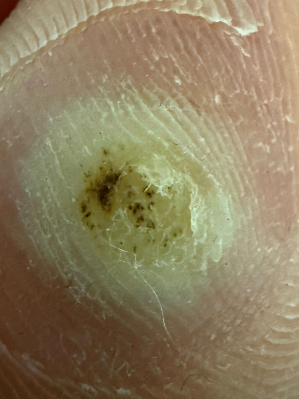 족저사마귀-자가치료-6일차-사진