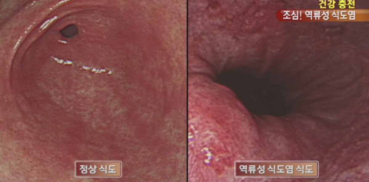 역류성 식도염, 정상 식도