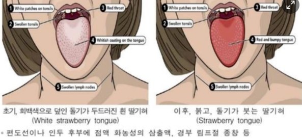 성홍열 이해
