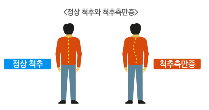 척추측만증 설명 사진