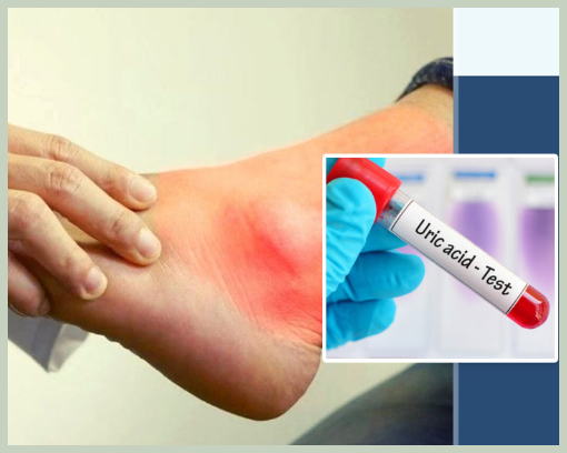 요산수치가 높으면 나타나는 증상