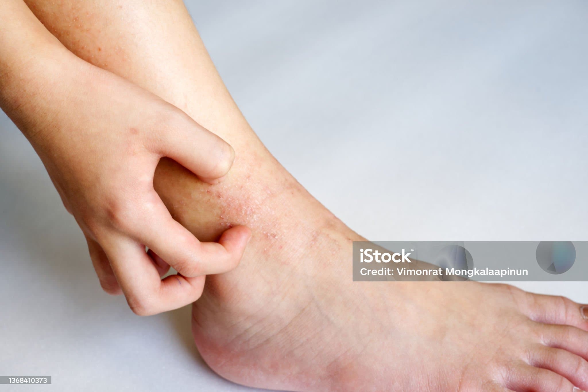 다리가 가려운 이유 무엇일까