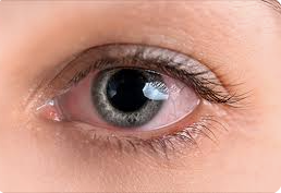 . 포도막염의 원인