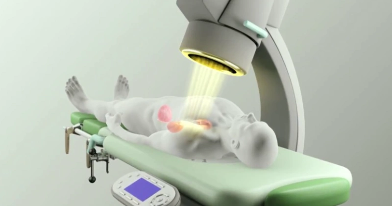 체외충격파 쇄석술