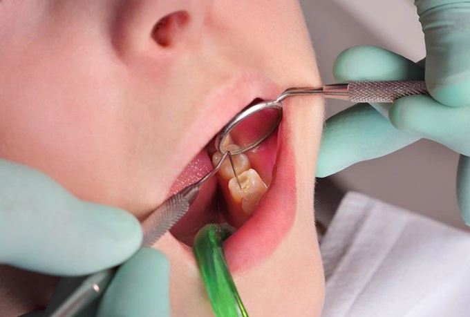 치아 우식단계별 증상 치료 