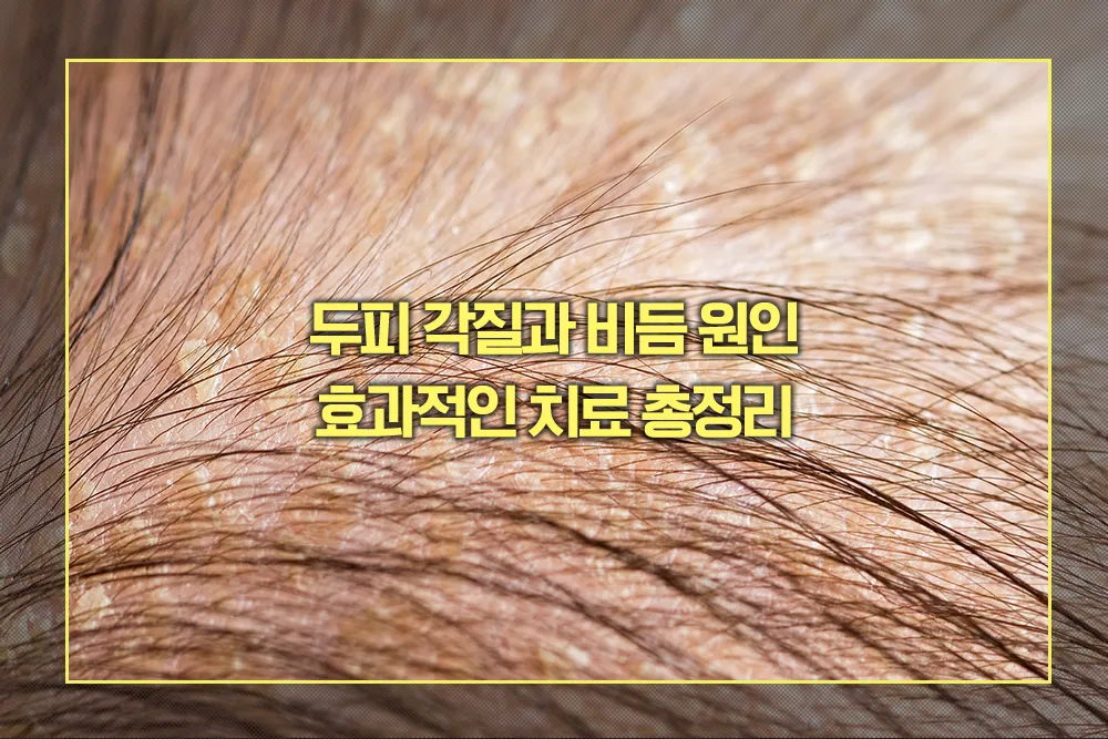 두피 각질 비듬 원인 및 치료