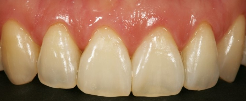 치간유두가 있는상태